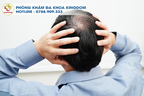 Những ai nên và có thể sử dụng phương pháp FUE