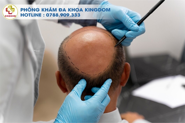 Cấy tóc FUE tại phòng khám Kingdom