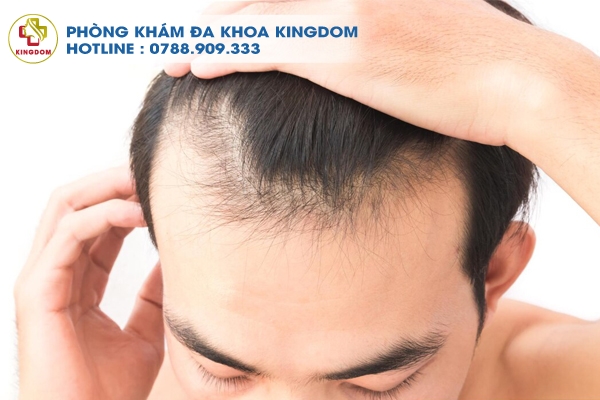Cấy tóc HAT, một trong những phương pháp được lựa chọn nhiều tại phòng khám Kingdom