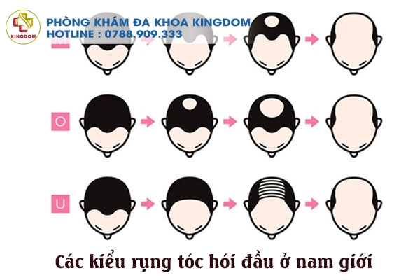 hói đầu ở nam