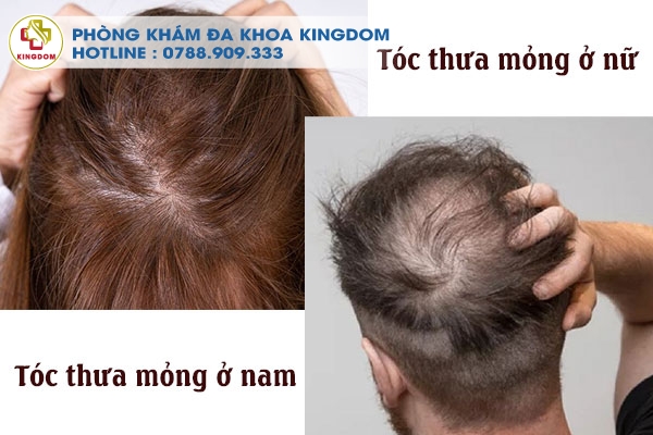 Tóc thưa mỏng ở nam và nữ